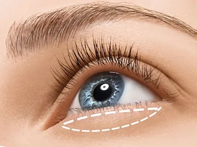 How Eyelid Surgery is Changing Lives in Dubai